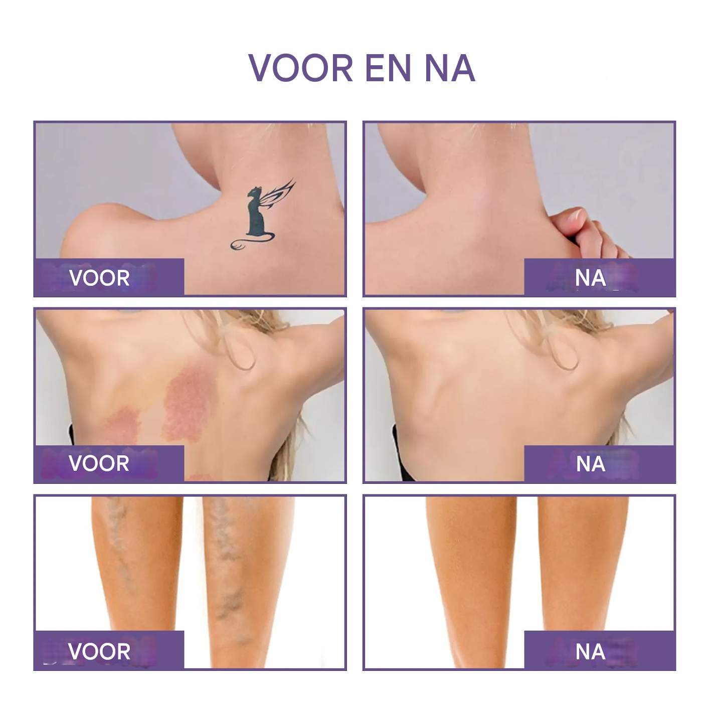 TrueSkin™ | Verbergt spataderen, littekens, pigmentvlekken en meer! | 1+1 gratis