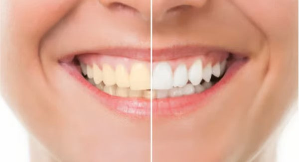 ProWhiten+™ | Wittere tanden en een frisse adem | 1+2 gratis