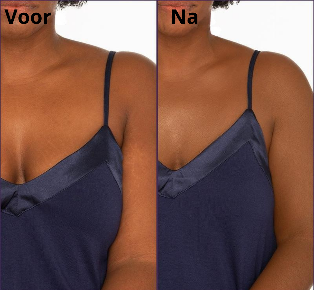 TrueSkin™ | Verbergt spataderen, littekens, pigmentvlekken en meer! | 1+1 gratis