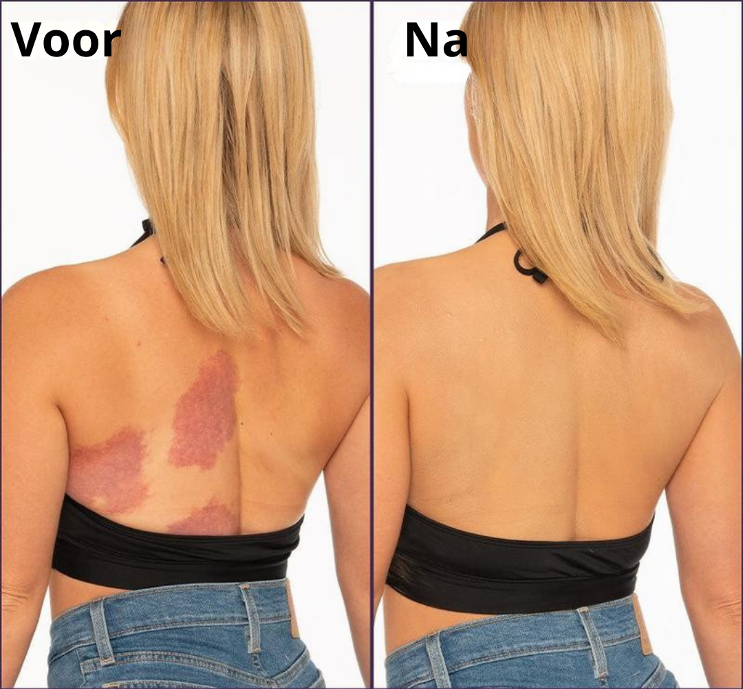 TrueSkin™ | Verbergt spataderen, littekens, pigmentvlekken en meer! | 1+1 gratis