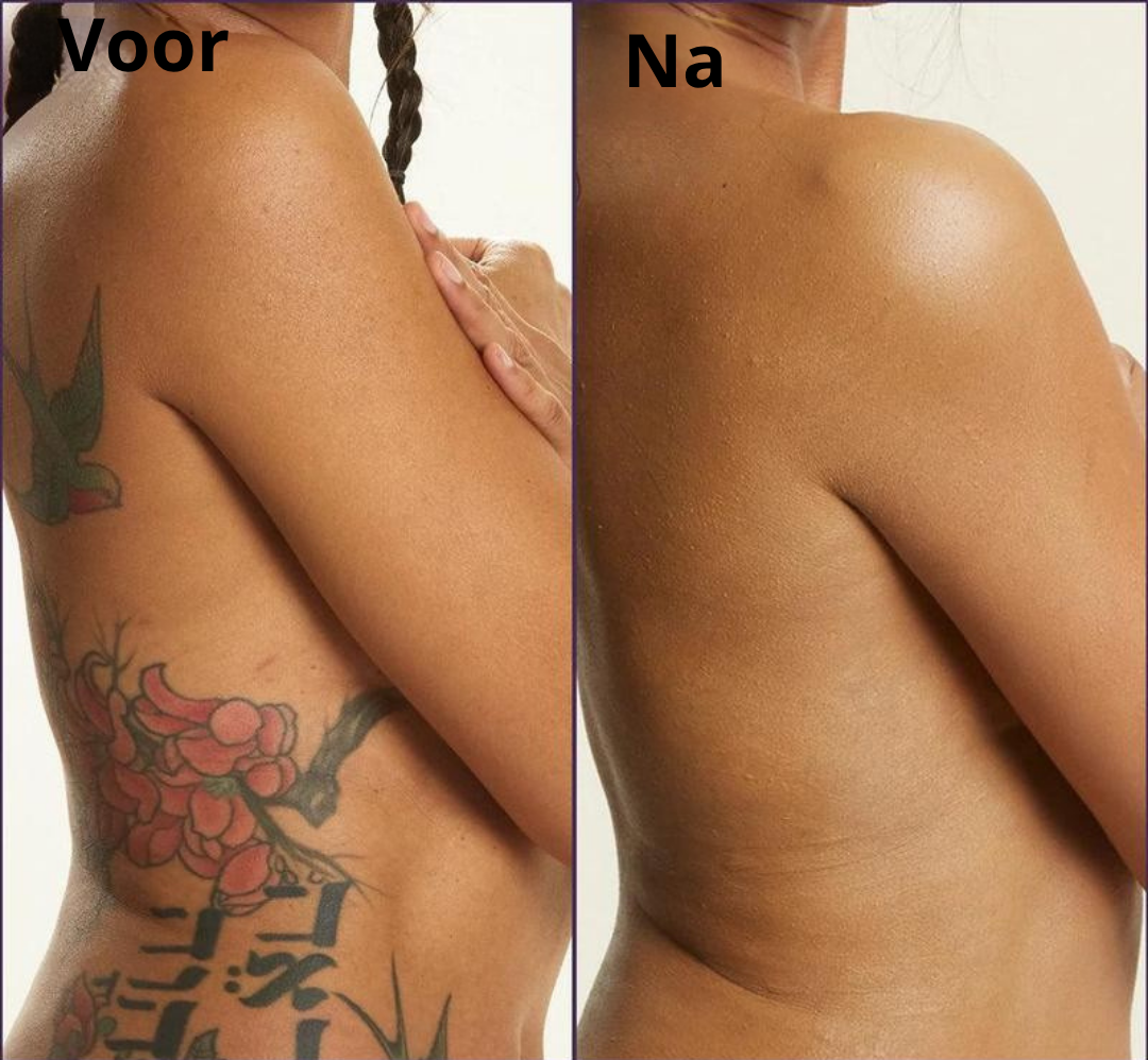 TrueSkin™ | Verbergt spataderen, littekens, pigmentvlekken en meer! | 1+1 gratis